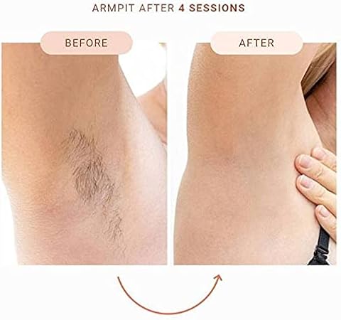 IPL Hair Removal System - Permanent Laser Hair Removal at Home for Face, Body, Bikini Line - Hair Removal Device for Painless Hair Reduction in Women and Men