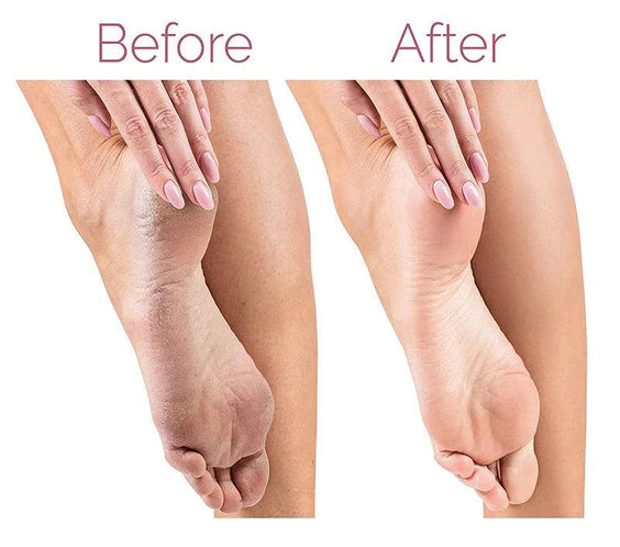 Electric Pedicure Foot File Callus Remover